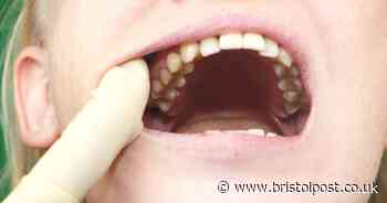 Dentist warns of four main signs of mouth cancer - including ulcers, white patches and neck lumps