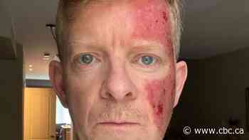 Jamie Campbell missed World Series broadcasts for 'pre-skin cancer' treatment. Here's how he's doing