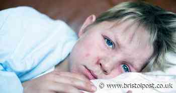 Symptoms of measles as outbreak declared with highly infectious Victorian illness on the rise