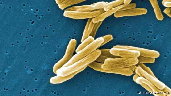 Active case of tuberculosis detected at University of Victoria