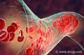 Mechanical Thrombectomy Safe, Effective for High-Risk Pulmonary Embolism