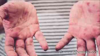 3 new cases of measles confirmed at Manatee Bay Elementary