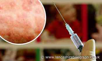 Measles virus confirmed in this Lancashire borough