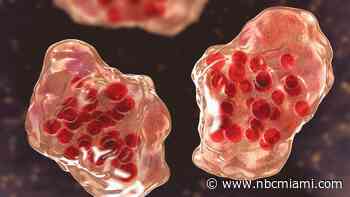 What is measles and why is it back in South Florida? Here's what to know