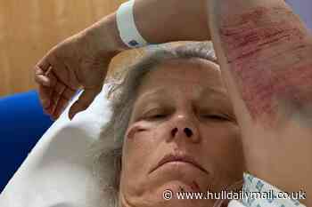 Dog walker suffers life-changing injuries when cows attack her at Yorkshire farm