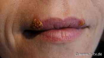 Studie untersucht Zusammenhang: Herpesviren können Alzheimer-Risiko verdoppeln