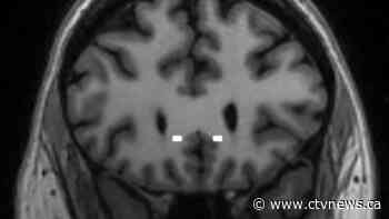 A pacemaker for the brain helped a woman with crippling depression. It may soon be available widely