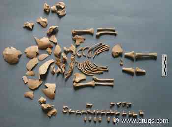 Remains Show Prehistoric Peoples Cared for Those With Down Syndrome