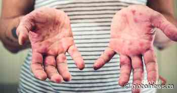 3rd case of measles reported in southern Ontario