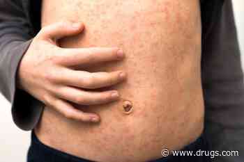 Vaccines Protect You & Your Kids From Measles: FDA