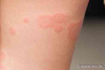 Warum sich in Kitas und Schulen die Ringelröteln-Fälle häufen