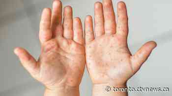 Ontario could be seeing 'sporadic' community transmission of measles