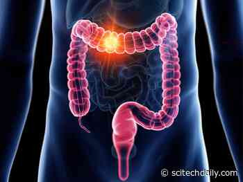 Decoding Efficacy: MIT Unveils the Surprising Truth About Colon Cancer Screenings