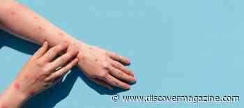 What Is Monkeypox and Should we Still be Worried About this Virus?