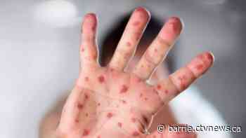 Health unit warns of potential measles exposure after 1st confirmed outbreak in Simcoe Muskoka