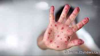 1st confirmed case of measles in Simcoe Muskoka is an immunized person & others may have been exposed