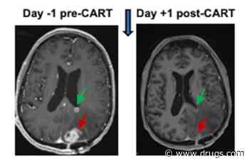 New Immune-Focused Therapy Shrinks Aggressive Brain Tumors