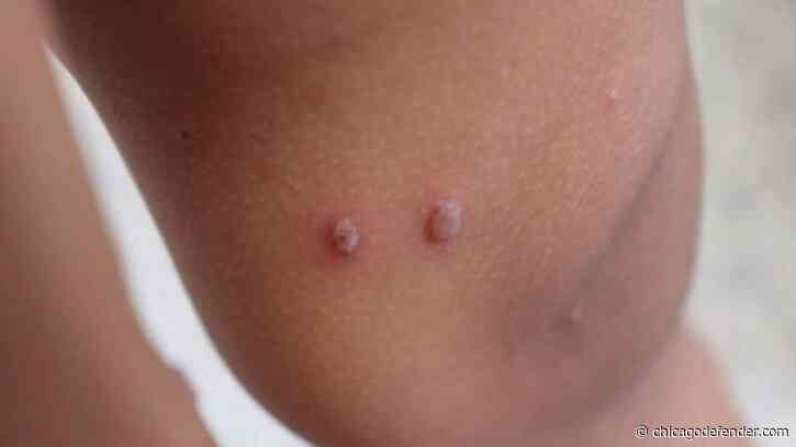 Measles 2024: What to Know About the Outbreak