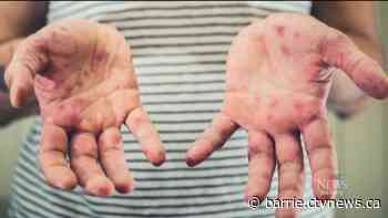 Simcoe County opens three measles immunization clinics