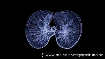 Tuberkulose-Fälle steigen in Deutschland – Unbehandelt ist sie die tödlichste Infektionskrankheit