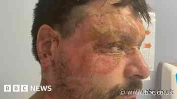 Firm fined over burns to football mascot's father