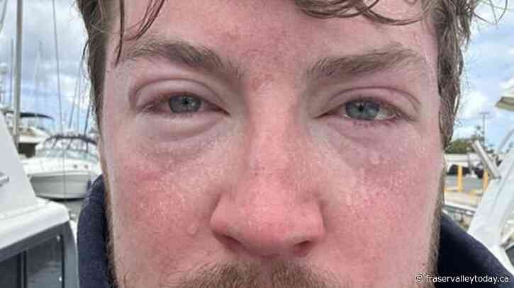 ‘Like a hot iron.’ B.C. man’s ultra-marathon Hawaiian swim is scuttled by jellyfish