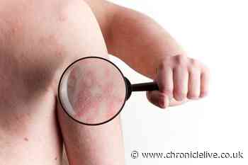 DWP list of skin conditions that could get you over £600 a month - check if you are eligible