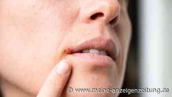 Studie deckt neuen Risikofaktor für Demenz auf – Herpes-Infektion hat enorme Auswirkung