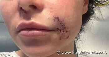 Mum claims pal's dog 'almost pulled her face off' when it latched onto cheek