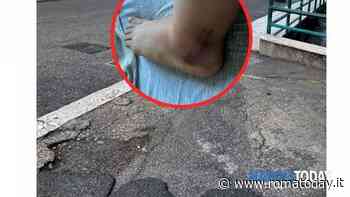 Cade in una buca e finisce in ospedale. Lo sfogo della laureanda: "Costretta a saltare il tirocinio"