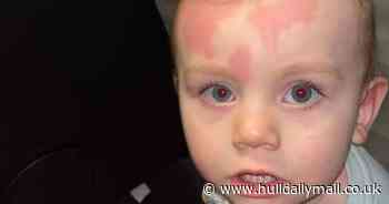 Toddler hospitalised with red welts after using Asda baby product