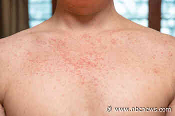 Measles elimination in the U.S. is under 'renewed threat,' CDC warns