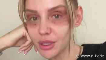 "Übel zugerichtet": Gerda Lewis leidet für die Schönheit