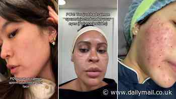 Beauty really IS pain! Bizarre new wrinkle-defying trend that involves paying £400 to get salmon sperm injected into your face is bruising women (and it takes up to six months for effects to kick in)