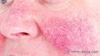 Erenumab Effective, Safe for Rosacea-Linked Erythema, Flushing