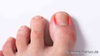 Eingewachsener Zehennagel: Das hilft gegen die schmerzhafte Entzündung