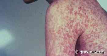 Person with measles visited Edmonton airport, Stollery Children’s Hospital: AHS