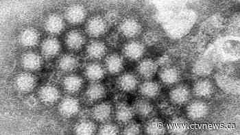 Is it cold, flu or norovirus? Symptoms explained