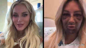 „Wie ein Monster“: Model lässt sich Zähne implantieren – und hat heftige Nebenwirkungen