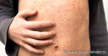 Mazelen ontdekt bij ongevaccineerd kindje van bijna 2 jaar: eerste geval in Zuid-Holland