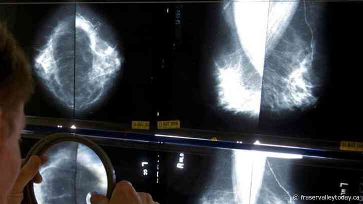 Breast cancer screening should start at age 40, Canadian Cancer Society says