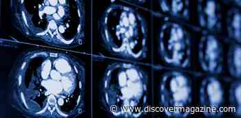 Lung Cancer Is The Deadliest, Screening Could Save Many Lives