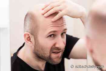 Microneedle Magic: New Alopecia Treatment Can Reverse Hair Loss