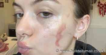 Student's horror when Heinz spaghetti hoops explode in her face leaving her with hoop-shaped burns