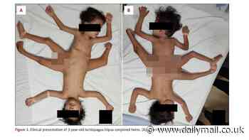 Ultra rare 'spider twins' have three legs, four arms and one penis
