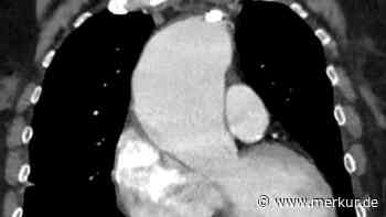 Aorta-Alarm: Münchner Herzchirurgen warnen vor Riesen-Aneurysma - „Bei Riss oft tödlich“