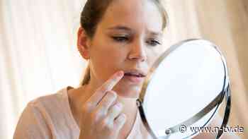 Warentest gegen Bläschen: Kein Lippenherpes-Mittel bringt schnelle Heilung