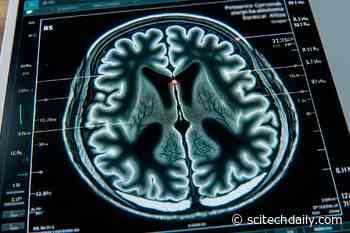 Researchers Identify New Genetic Form of Alzheimer’s Disease