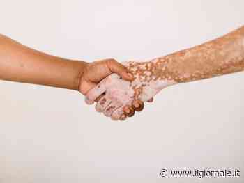 Vitiligine, ora l'Aifa rimborsa il primo trattamento specifico