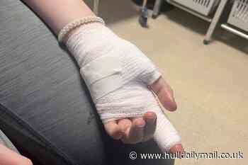 Girl, 12, scarred for life as TikTok challenge turned to 'prison napalm'